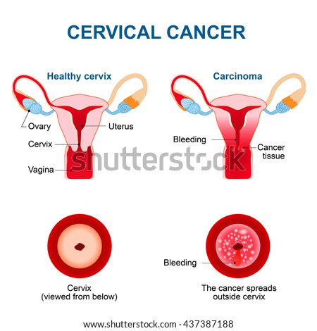 Cervical Cancer. Carcinoma of Cervix. Maligna